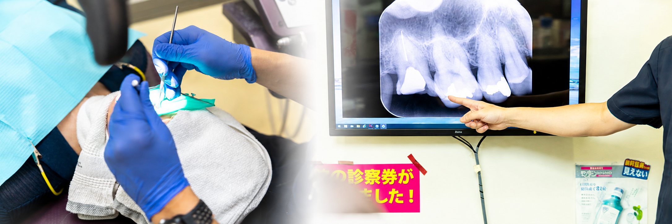 ラバーダム防湿・ニッケルチタンファイル等の使用について